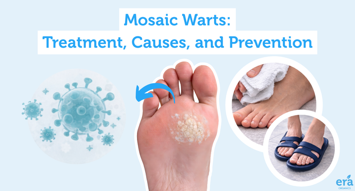 Mosaic Warts: Treatment, Causes, and Prevention