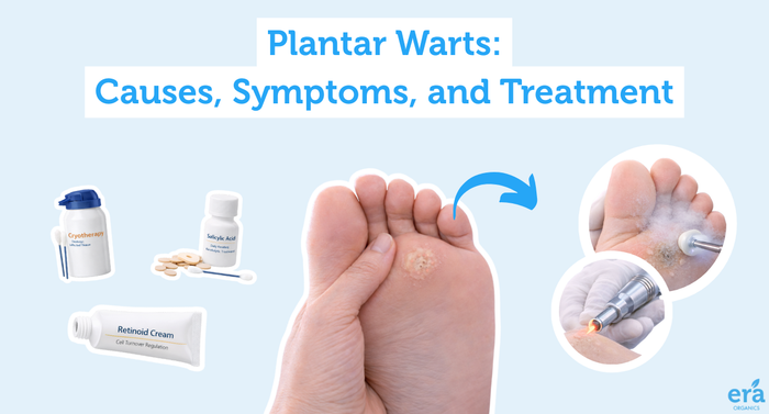 Plantar Warts: Causes, Symptoms, and Treatment
