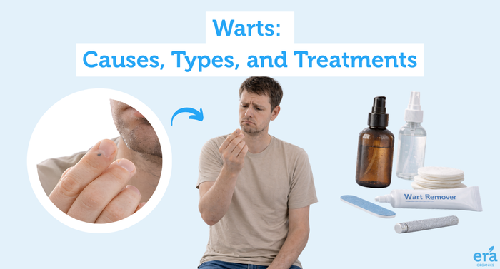 What are the Different Types of Warts?